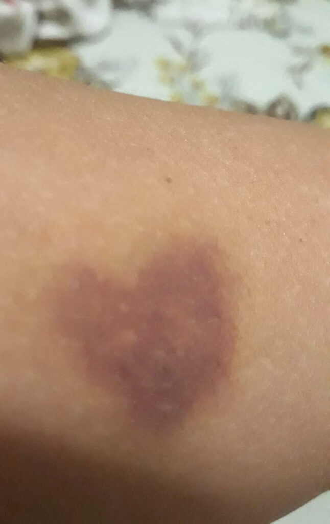 Desaparecimento de hematoma