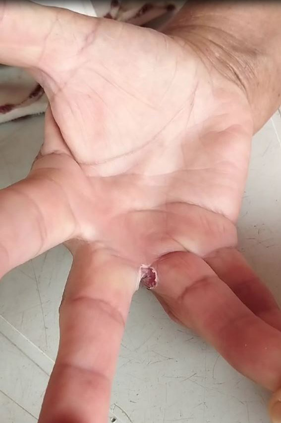 cicatrização de ferida entre os dedos