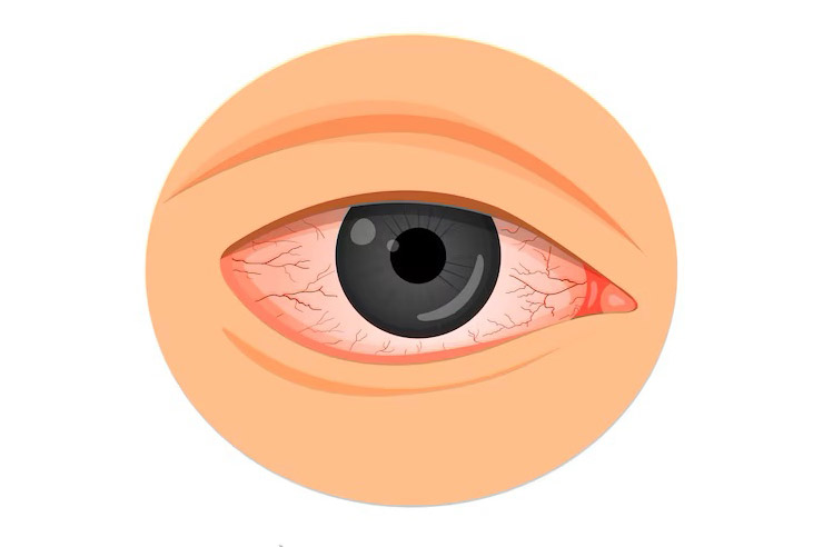 Alergia nos olhos