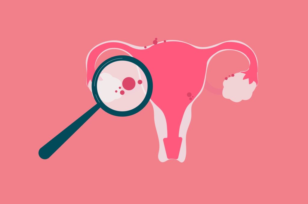 Endometriose